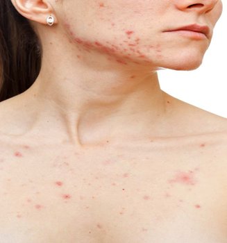 Imagem De Modelo Branca Com Acne No Peito