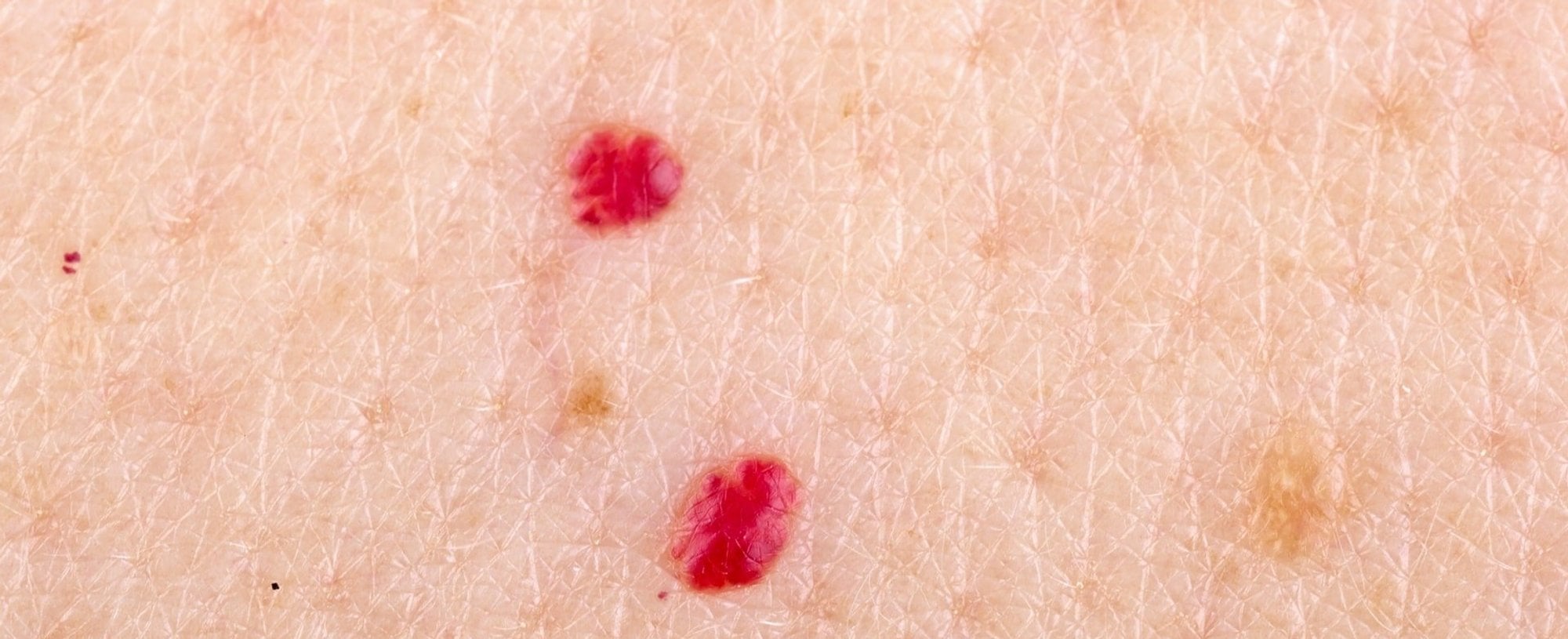 Marcas Rojas Manchas rojas en la piel: qué son, cómo tratarlas y prevenirlas